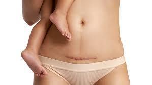 Mom holding baby, can see her stomach and c section scar and babies legs