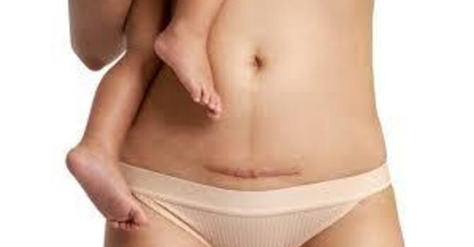 C-Section Scar Recovery: How Acupuncture and Cupping Can Help Heal Your Body image